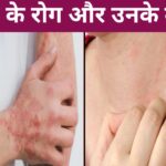 त्वचा के रोग और लक्षण